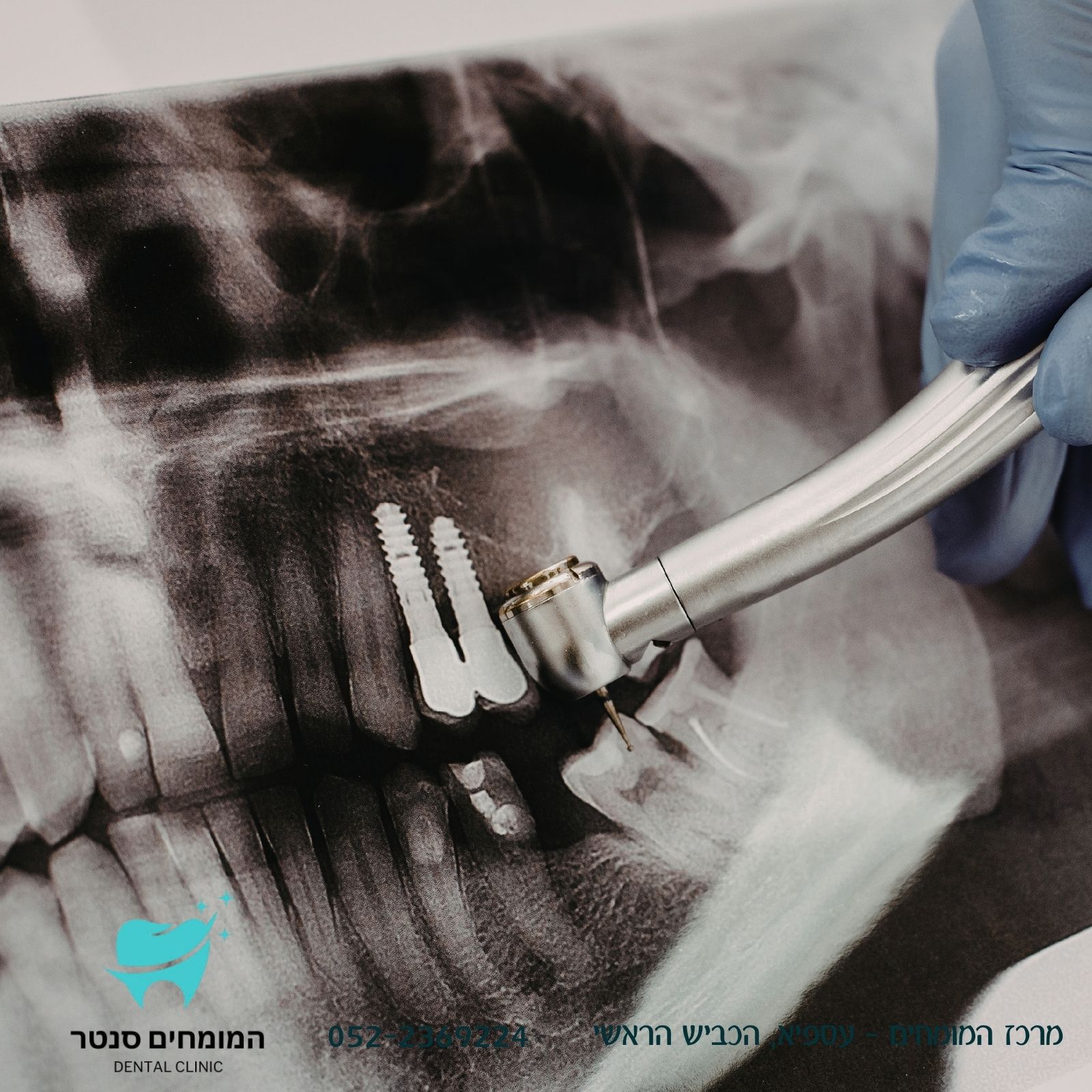 תהליך השתלת שיניים